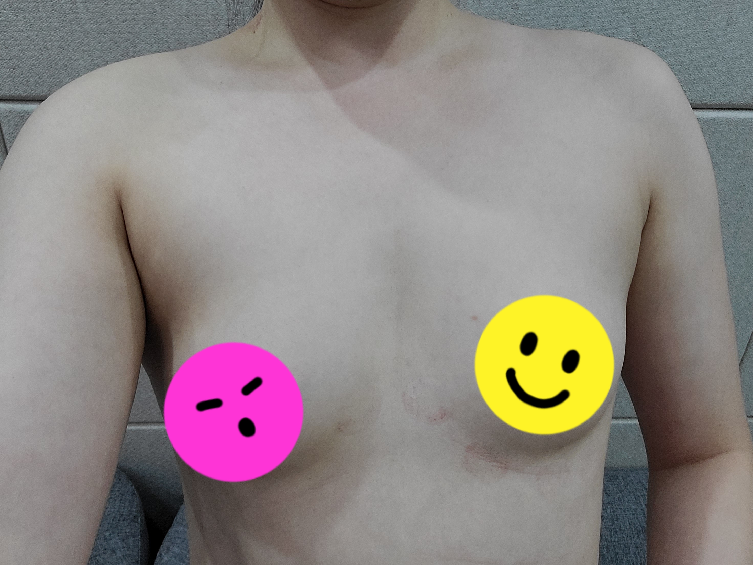 1 month after breast augmentation ♡