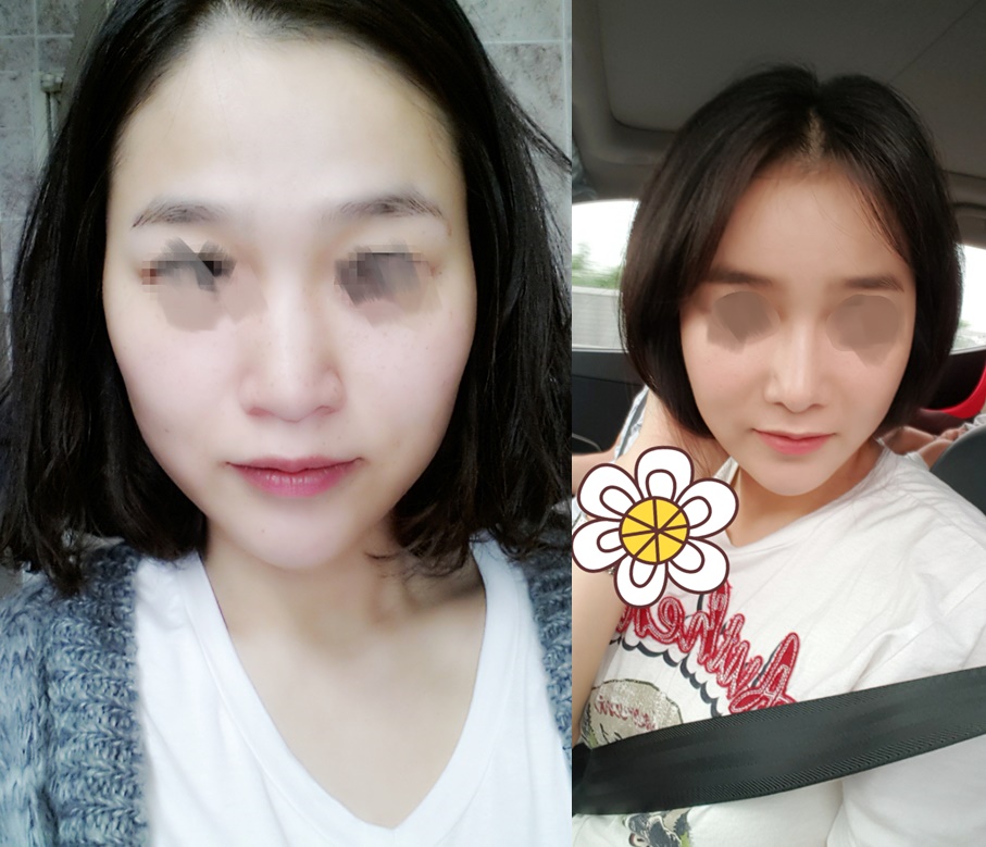 안면윤곽+Rhinoplasty+전체지방이식 2년