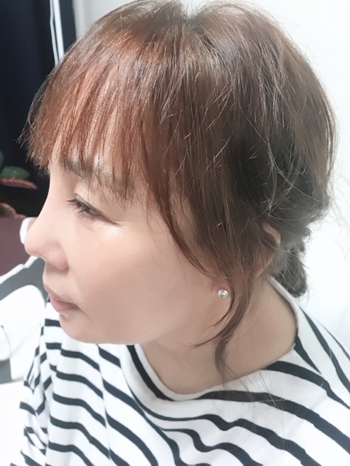 눈,Rhinoplasty,리프팅 5개월차