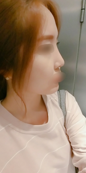 Rhinoplasty성형 2개월째 후기입니다~