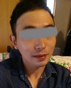 남자 안면윤곽 Rhinoplasty 수술 6개월