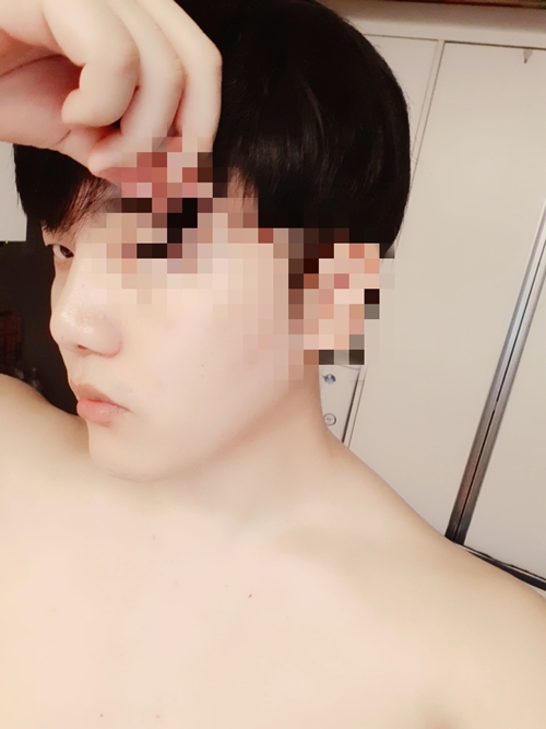 남자 낮은Rhinoplasty수술 6개월차 후기입니다