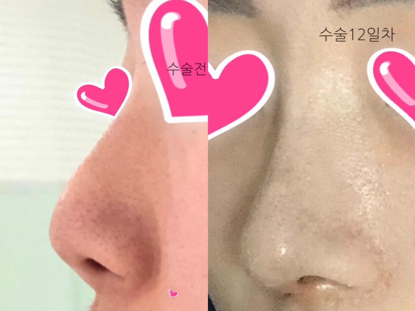 Rhinoplasty수술 1개월차~