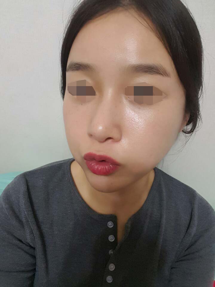 안면윤곽+Rhinoplasty+지방이식 10개월됬어요^^