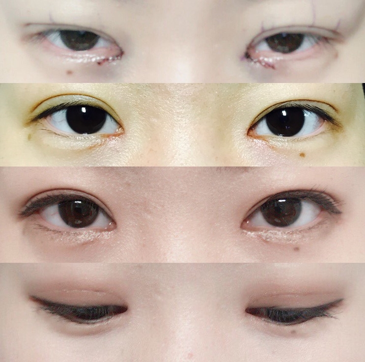 부분절개,앞트임 한달 후기!!