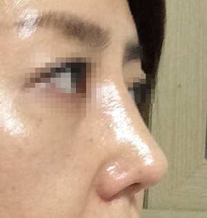 Rhinoplasty수술 1개월~~