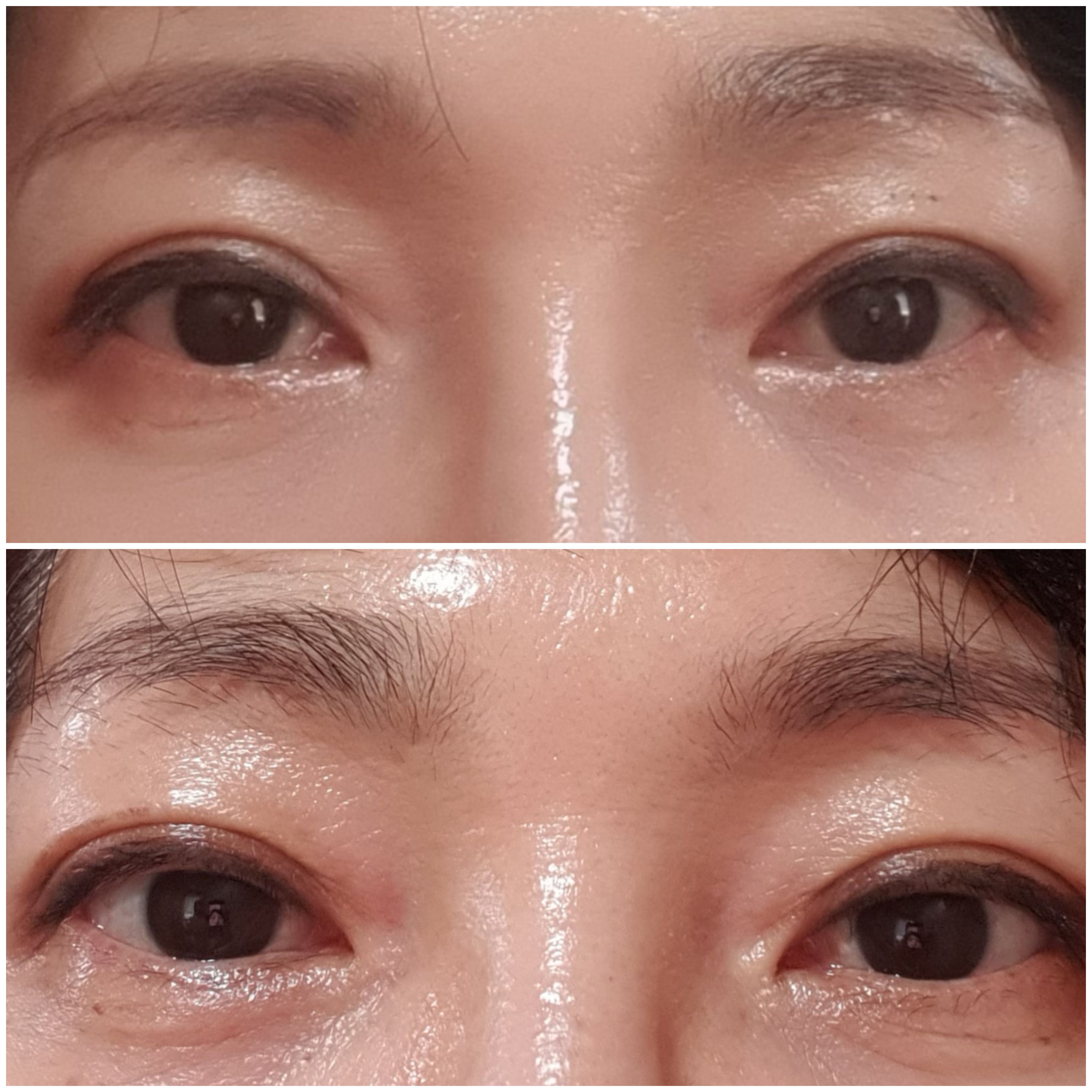 Double eyelid sagging surgery