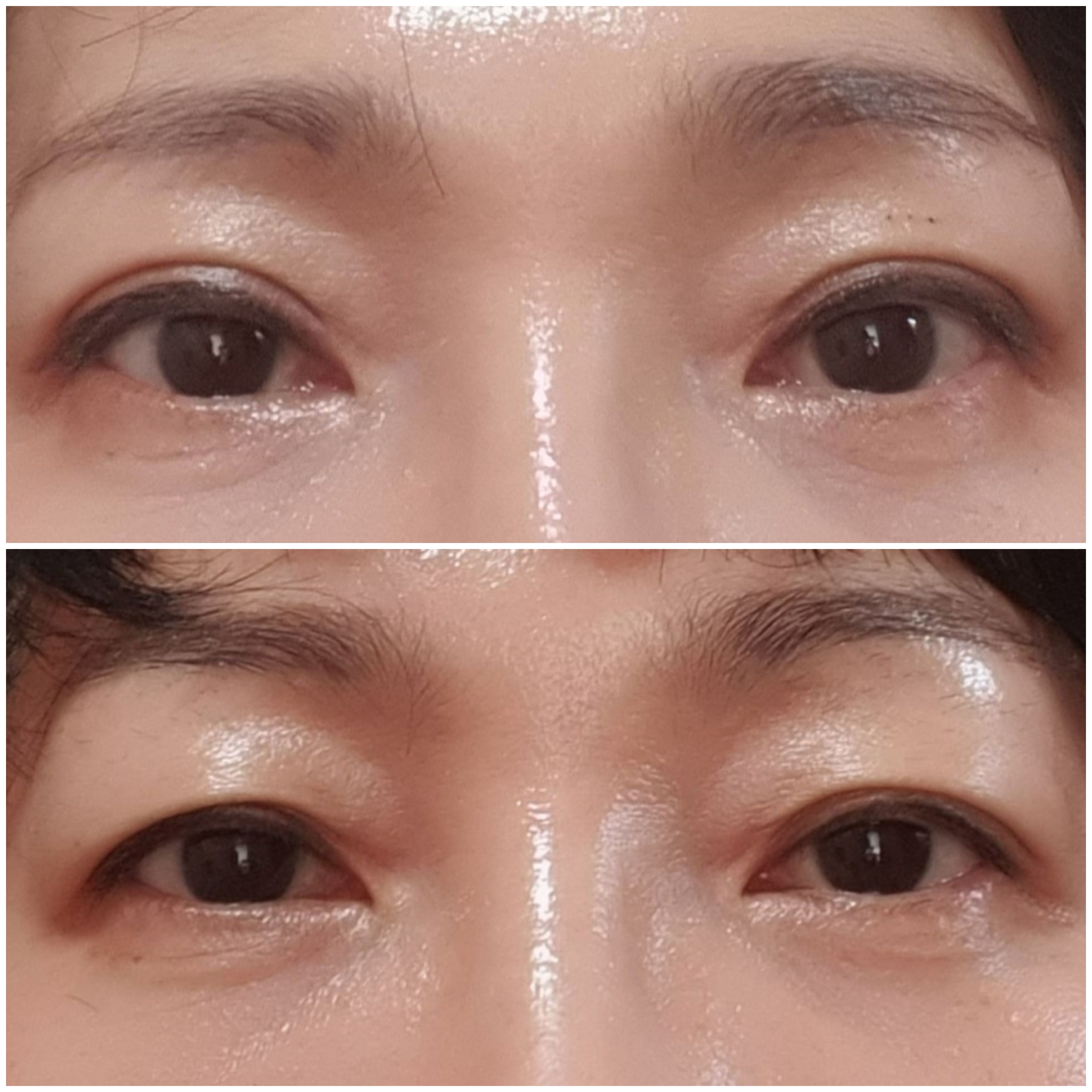 나이들어 쌍꺼플 처짐수술 후기~~^^