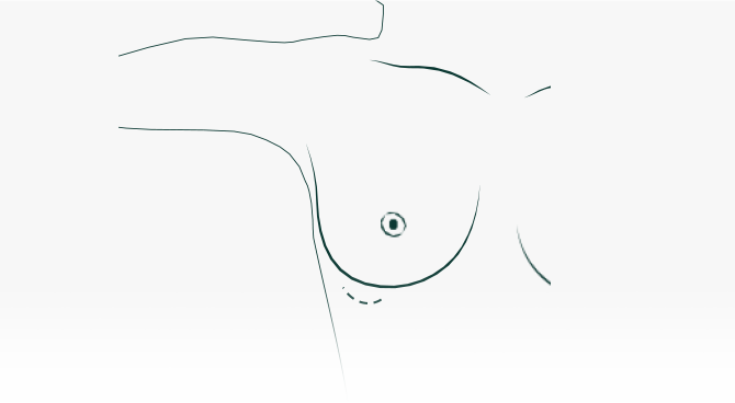 Minimal Incision