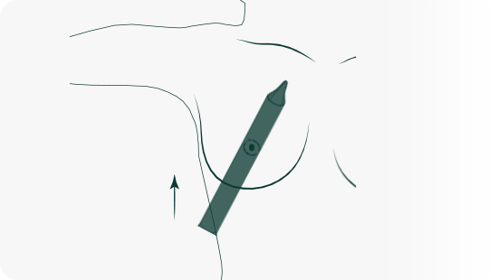 Tissue Expansion