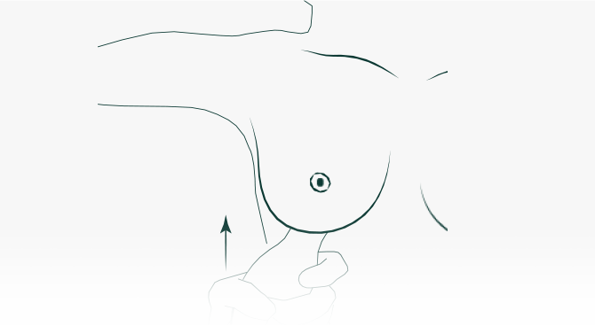 Tissue Expansion