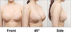 Photo guide for breast: front, 45 degree, and side views
