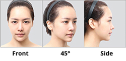 Photo guide for face: front, 45 degree, and side views