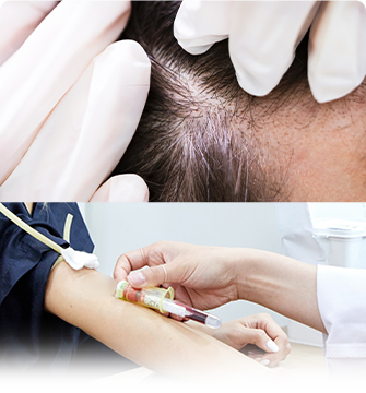 Pre-hair transplant surgery test 2: Blood test