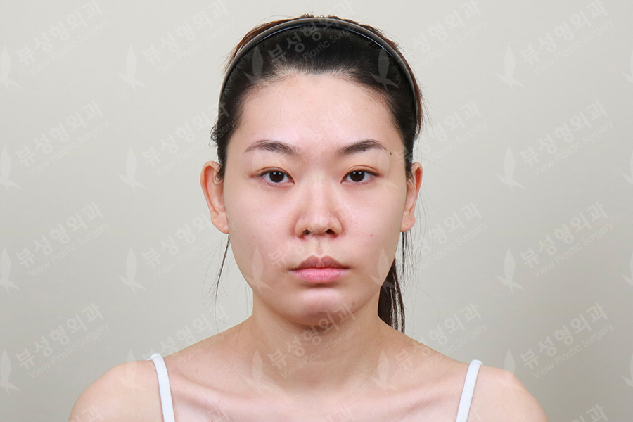 Facial Contouring Surgery Korea: 3D Cheekbone, Face Sculpting - The Line  Clinic