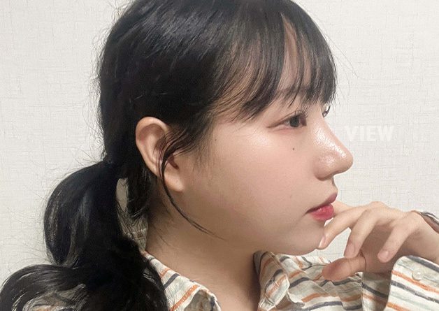 [Rhinoplasty] Visit View Plastic Surgery and get a consultation! They perform the best rhinoplasty in Korea.