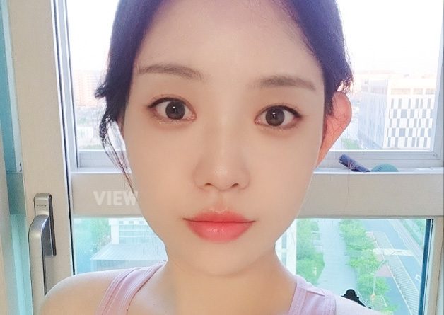 [Anti-aging + Eye Surgery] All of my friends praise me for getting prettier !