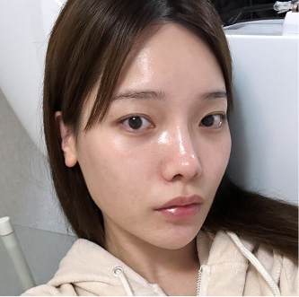 facial contour sec03 bottom after1 mo