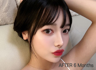 facial contour sec03 bottom after6m mo