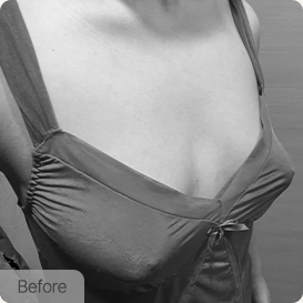 breast lift episode01 pc