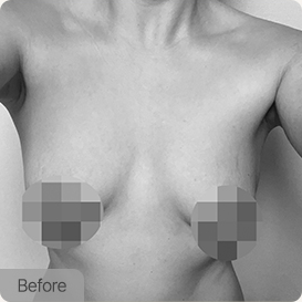 breast lift episode03 pc