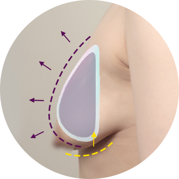 breast lift surgical02 pc