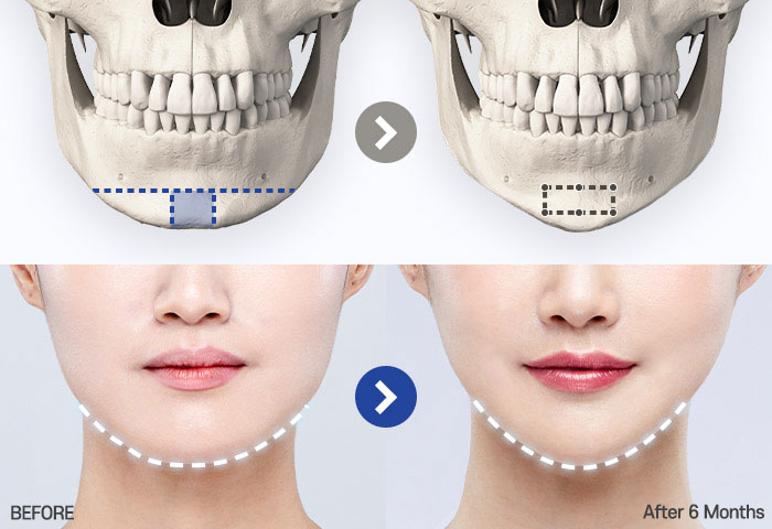 genioplasty tab 01 mo