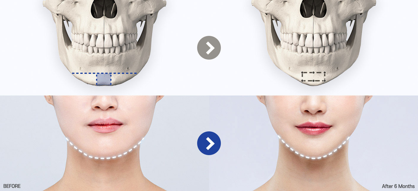 genioplasty tab 01 pc