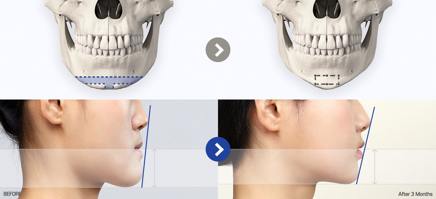 genioplasty tab 02 pc