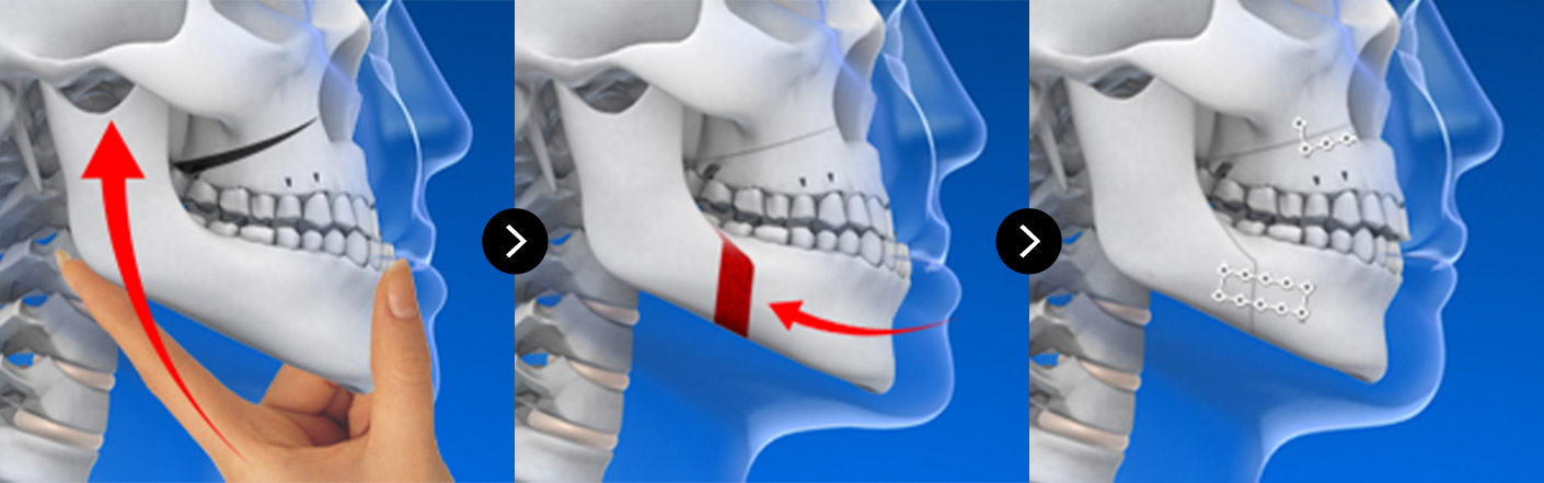 VIEW Double Jaw & ASO 31 jaw main sec 03 pc