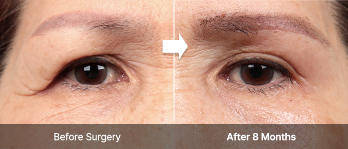 browlift correct 02 mo