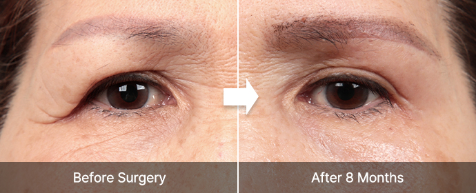 browlift correct 02 pc