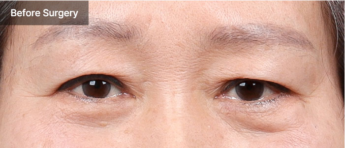 browlift qna 01 mo