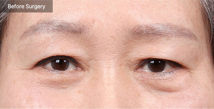 browlift qna 01 pc