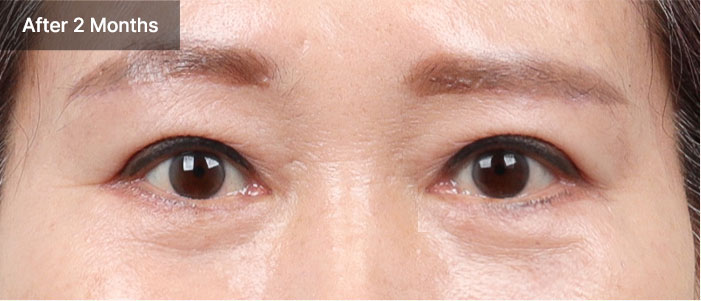 browlift qna 02 mo