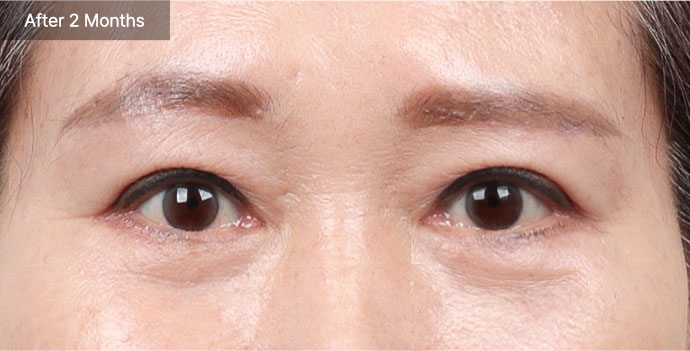 browlift qna 02 pc