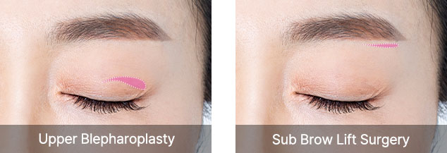 browlift qna 03 mo