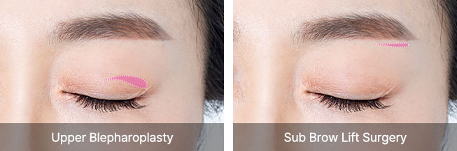 browlift qna 03 pc