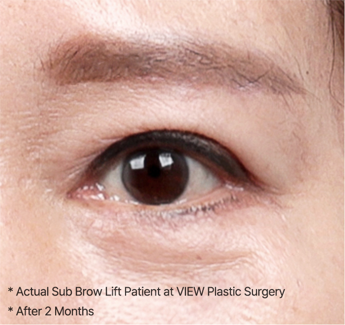 browlift slide 03 mo