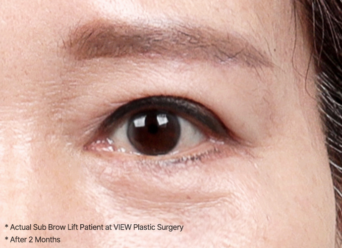 browlift slide 03 pc