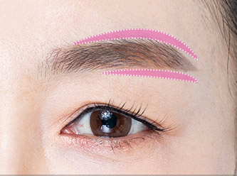 browlift step 01 mo