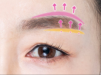 browlift step 02 mo