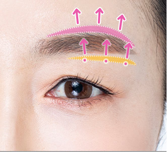 browlift step 02 pc