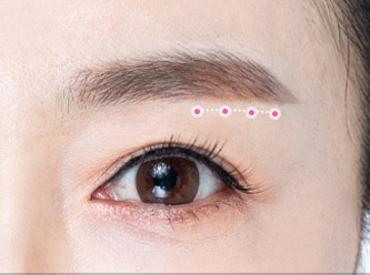 browlift step 03 mo