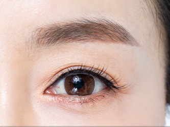 browlift step 04 mo