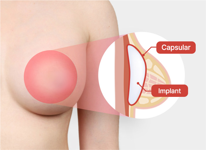 01. 구형구축이 생긴 경우