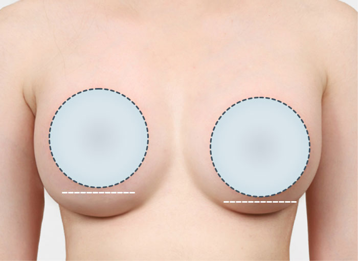 02. 양쪽 가슴이 비대칭인 경우