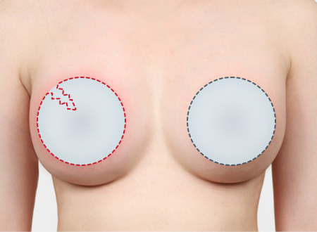 05. 보형물이 파열된 경우