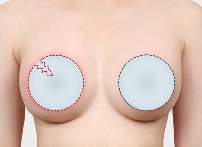 05. 보형물이 파열된 경우