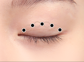 correction surgery 1 3 mo